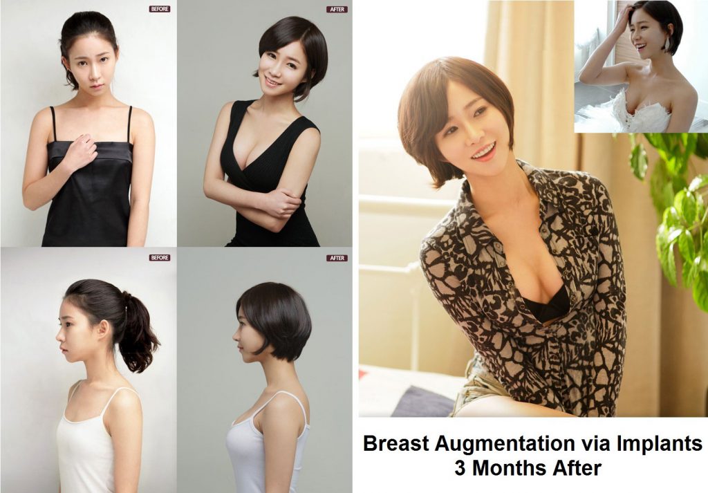 breast augmentation in korea