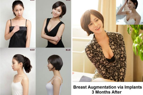 breast augmentation in korea