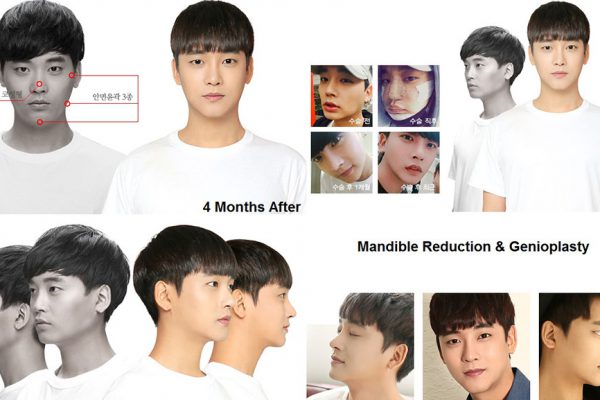 male plastic surgery in korea