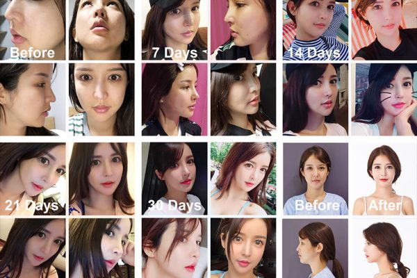 4 Irene Rhinoplasty Before Photo Seoul Guide Medical full