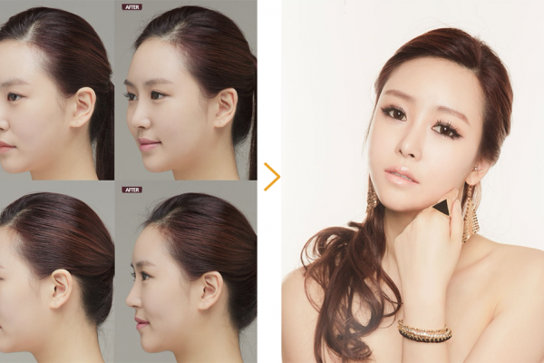 Nana Rhinoplasty before and after 1 seoul guide medical full