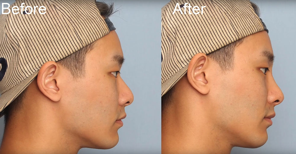 Haeppy We Fancy non-surgical rhinoplasty at seoul guide medical