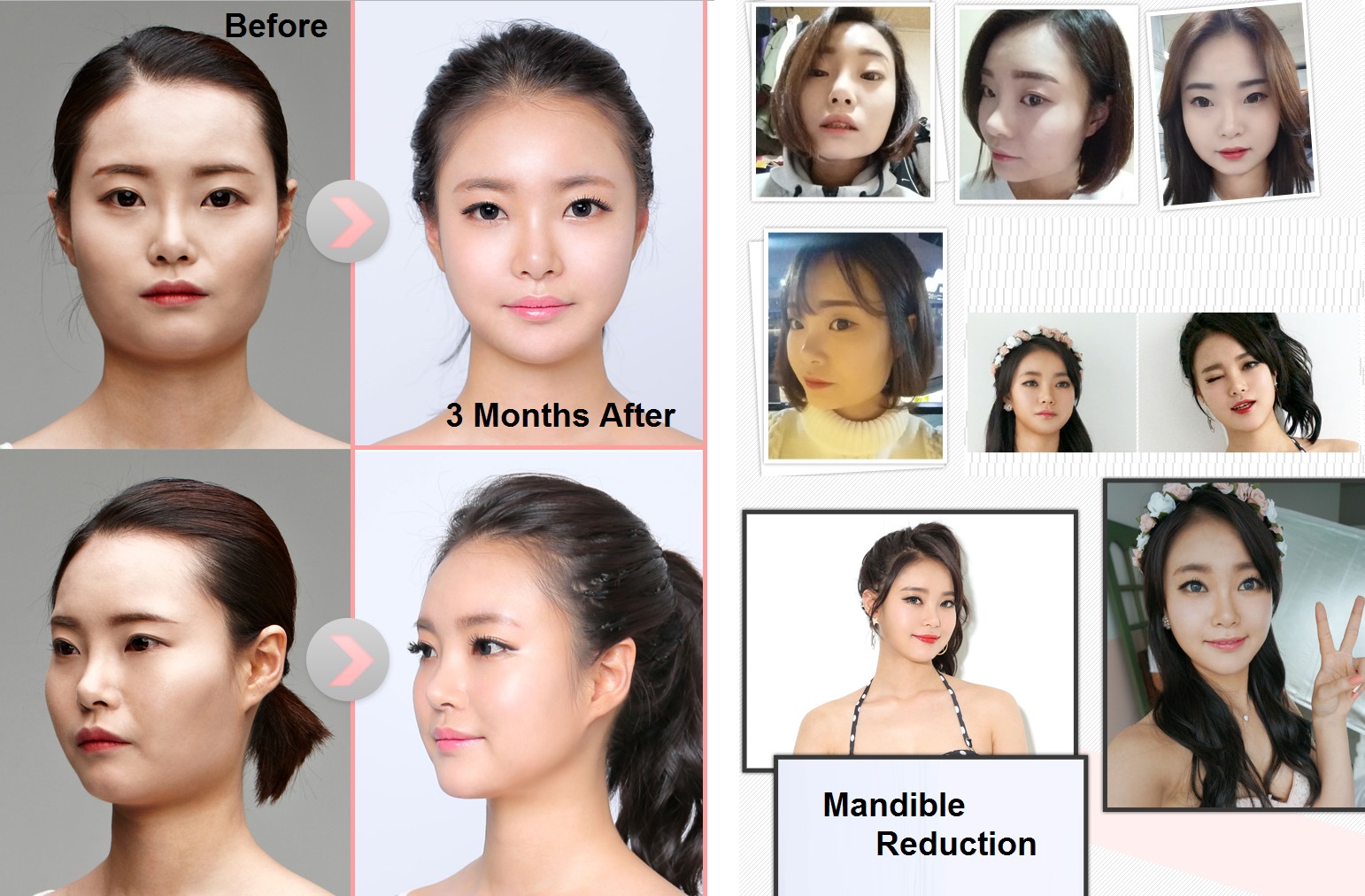 best korean plastic surgery before and after