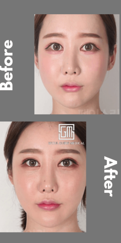 seoul guide medical revision double eyelid surgery before and after