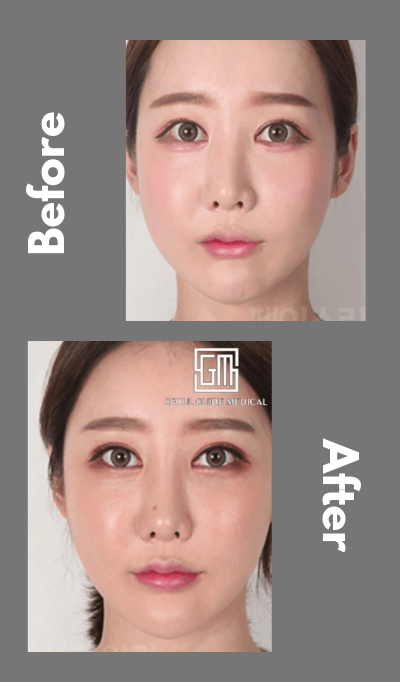 seoul guide medical revision double eyelid surgery before and after