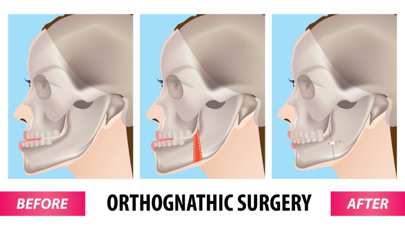 orthognathic surgery procedure