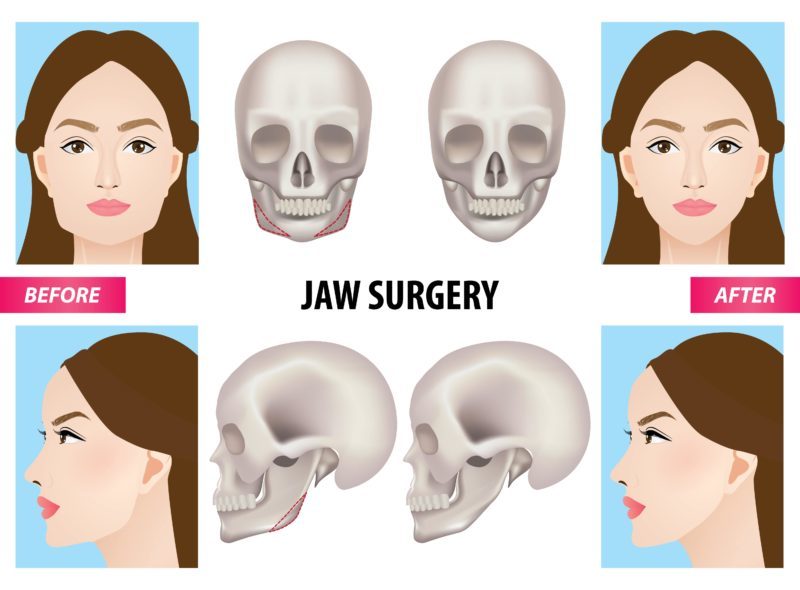 Jaw Surgery In Korea Costs Recovery Before After Seoul Guide 