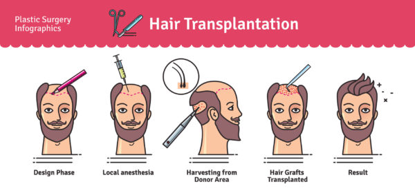 hair transplant korea