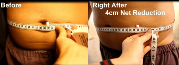 Non-Surgical liposuction before and after treatment